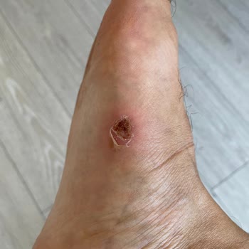 Crocs Terlik & Ayakkabı Crocs Terliği Ayağımı Yara Yaptı, İade Talep Ediyorum!
