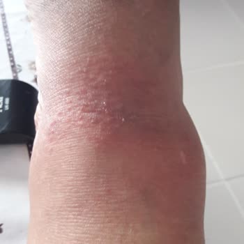 FLO Ayakkabı Alerji Yaptı Çözüm Bulunmasını İstiyorum.