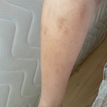 Riomi Hnk Teknoloji Lazer Epilasyon Aleti İade İşlemi