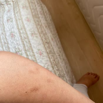 Riomi Hnk Teknoloji Lazer Epilasyon Aleti İade İşlemi