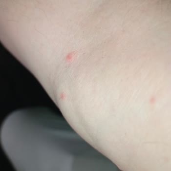 Enterogermina Alerji Yapıyor Dikkat