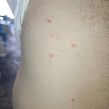 Enterogermina Alerji Yapıyor Dikkat