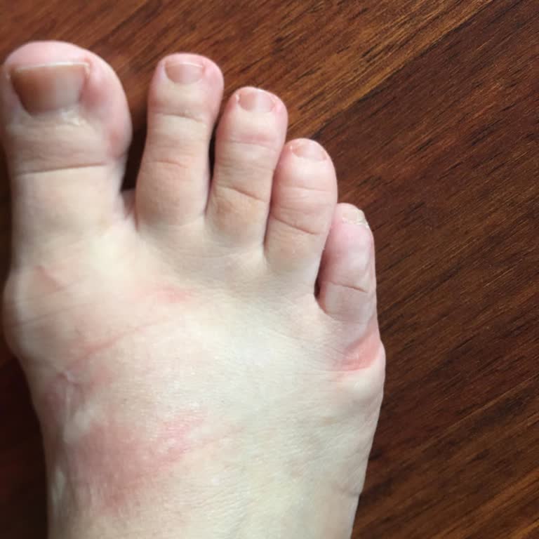 FLO Ayakkabı FLO Sandaletleri Ayağımı Mahvetti, Mağduriyetimin Giderilmesini İstiyorum!