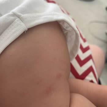 Mustela Güneş Kremi Bebeğimde Alerji Yaptı