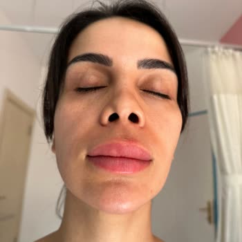 Özel Fatih Hastanesi'nde Burun Estetiklerini Pratisyen Hekim Yapıyor