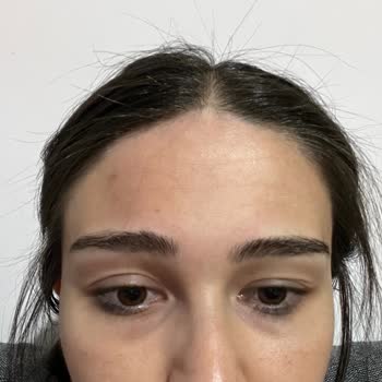 Dermaplus Klinik Yapılan İşlemler Sonucu Hayal Kırıklığı