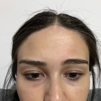 Dermaplus Klinik Yapılan İşlemler Sonucu Hayal Kırıklığı