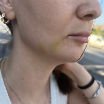 Dermaplus Klinik Yapılan İşlemler Sonucu Hayal Kırıklığı