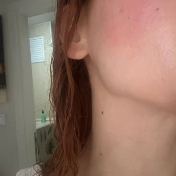 Loreal Paris Güneş Kremi Yüzümü Yaktı