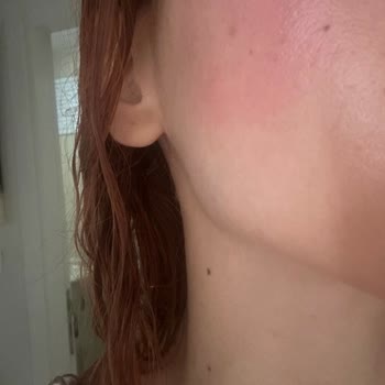 Loreal Paris Güneş Kremi Yüzümü Yaktı