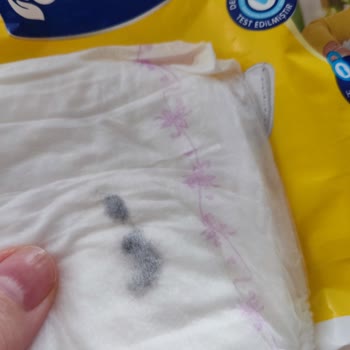 Canped Mesane Pedi İçinde Gömülü Siyah Madde