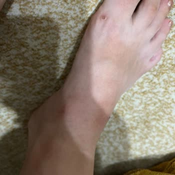 Deichmann Terlik Ayağa Yara Yapması