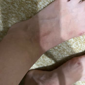 Deichmann Terlik Ayağa Yara Yapması