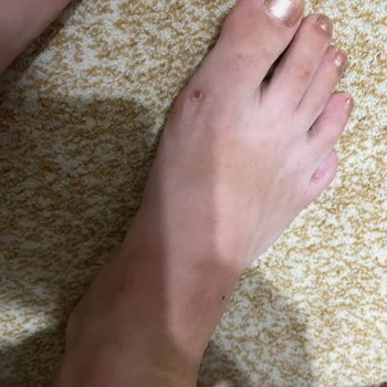 Deichmann Terlik Ayağa Yara Yapması