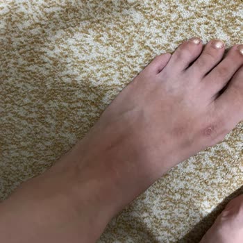 Deichmann Terlik Ayağa Yara Yapması