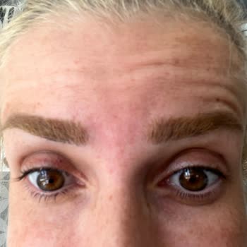 Dr. Sinan Akyürek Clinic Yanlış Botoks Uygulaması