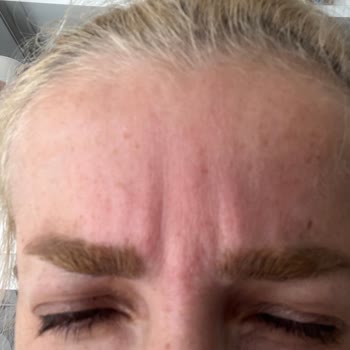 Dr. Sinan Akyürek Clinic Yanlış Botoks Uygulaması