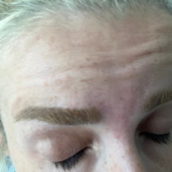 Dr. Sinan Akyürek Clinic Yanlış Botoks Uygulaması