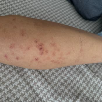 Buse Güzellik Merkezi Trabzon Şikayetim Var Diri Diri Yaktılar