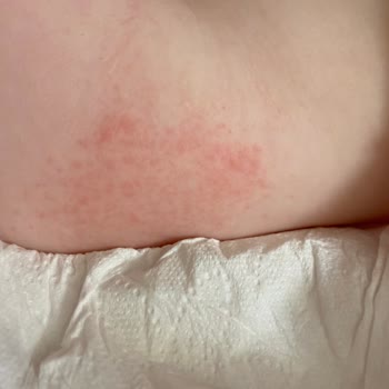 Bebem Natural Bebek Bezi Kullanımı Sonrası Cilt Sorunları