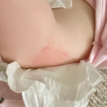 Bebem Natural Bebek Bezi Kullanımı Sonrası Cilt Sorunları