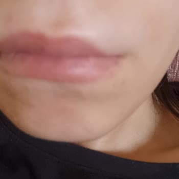 Este Nice Güzellik Merkezi Hatalı Dudak Dolgusu