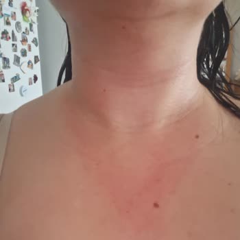 Loreal Paris Bright Reveal Güneş Kremi Yüzümü Tahriş Etti