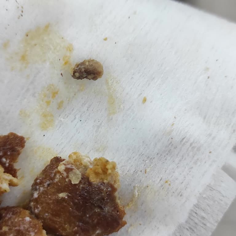 Acılı Dürüm Kemik Çıktı