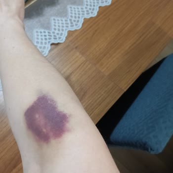 Özel Optimed Hastanesi Çerkezköy Optimed İn Damar Yolu Açamayan Personeli!