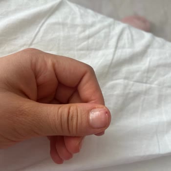 Gratis Beauty Ankara Antares Tırnak "Kazıma! " Faciası