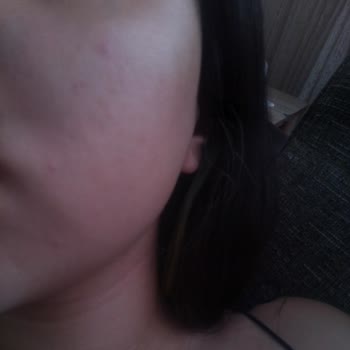 New Well Güneş Kremi Sivilce Problemi