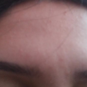 New Well Güneş Kremi Sivilce Problemi