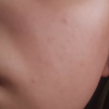 New Well Güneş Kremi Sivilce Problemi