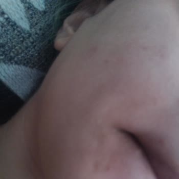 New Well Güneş Kremi Sivilce Problemi