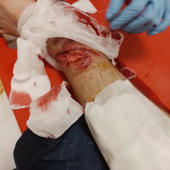 Gp Kompozit Koruma Demiri Kırıldı Ayağımı Kesti