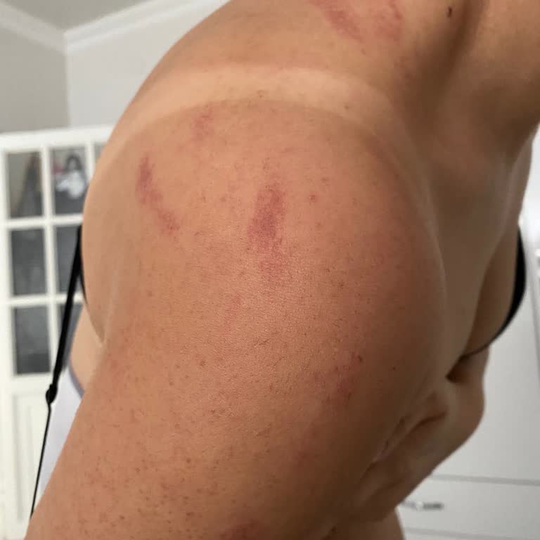 Lavinya Golden Malatya Malatya Lavinya Golden Lazer Yaparken Yakıyor İnsanları