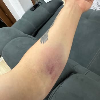 Gisbir Hastanesi Kan Alırken Damarımı Patlattılar