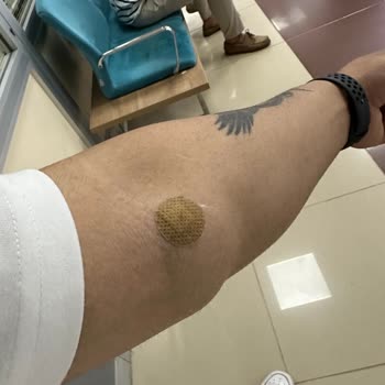 Gisbir Hastanesi Kan Alırken Damarımı Patlattılar