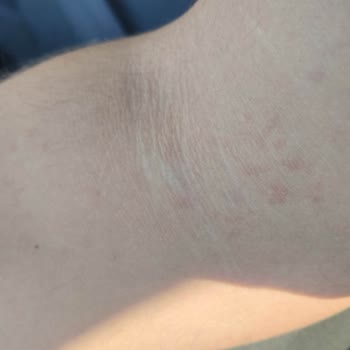 Harras Alerjik Reaksiyon Gösterdi