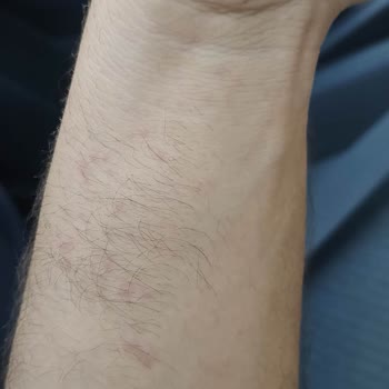 Harras Alerjik Reaksiyon Gösterdi