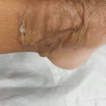 Tefal Air Frayer Sapı Koptu Çocuğum Yandı