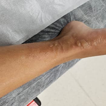 Tefal Air Frayer Sapı Koptu Çocuğum Yandı