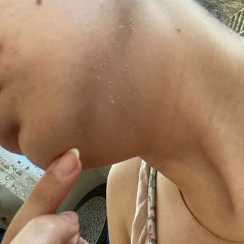 Bioderma Güneş Kremi Yüzümde Soyulması