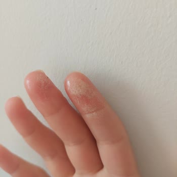 Vanish Kosla Migros Şikayet Parmaklarım Yandı