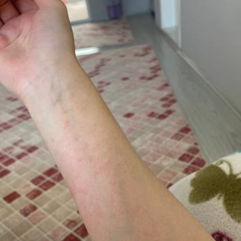 Mustela Çatlak Kremi Alerji Yaptı!