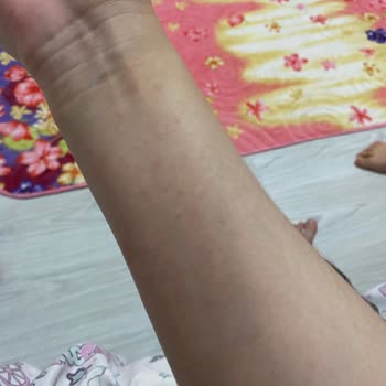 Mustela Çatlak Kremi Alerji Yaptı!