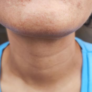 Loreal Paris L'Oreal Bright Reveal Güneş Kremi Cildimi Tahriş Etti