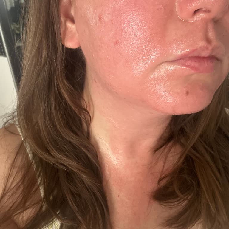 Bee Beauty Maske Yüzümü Yaktı