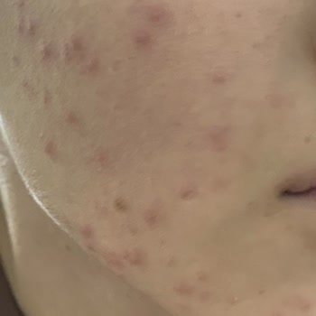 Gratis Lykd Fixing Powder Kullanımı Sonrası Cilt Sorunları