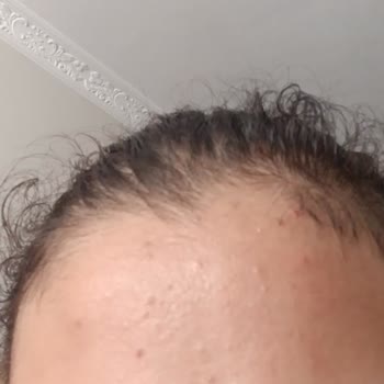 La Roche-Posay Güneş Kremi Sivilce Sorunu